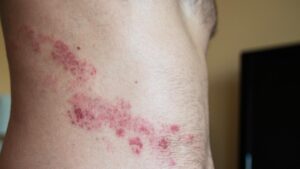 Der Bauch eines Mannes mit einem Herpes Zoster Ausschlag. (c) AdobeStock