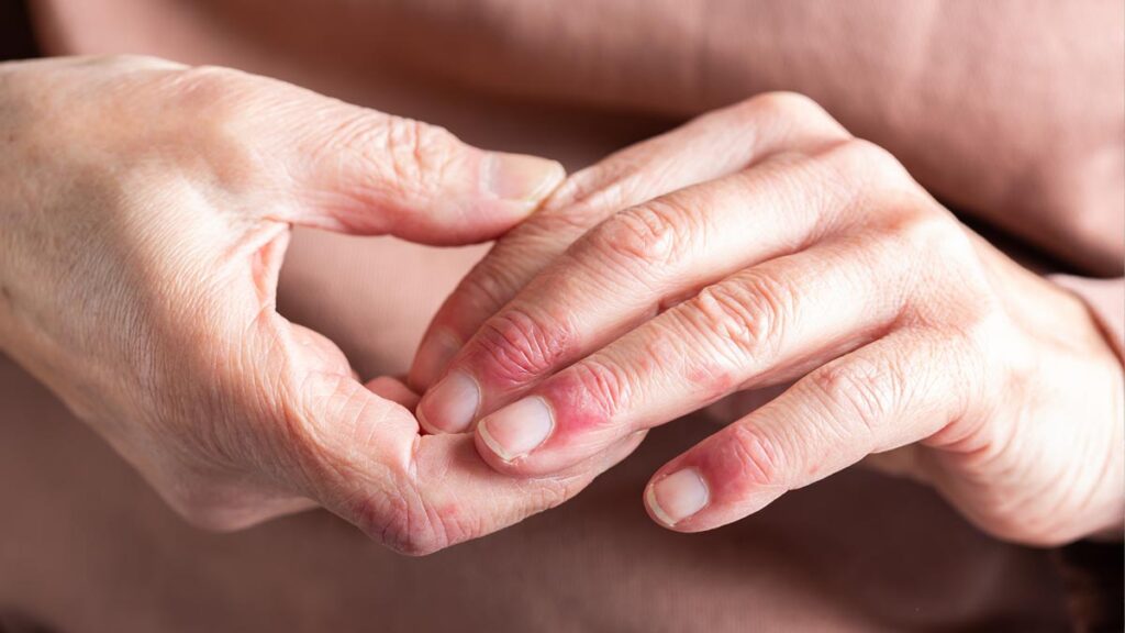 Die Hände/ Finger einer alten Frau mit Neurodermitis. (c) AdobeStock